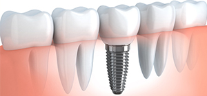 Dental Implants in Willmar, MN